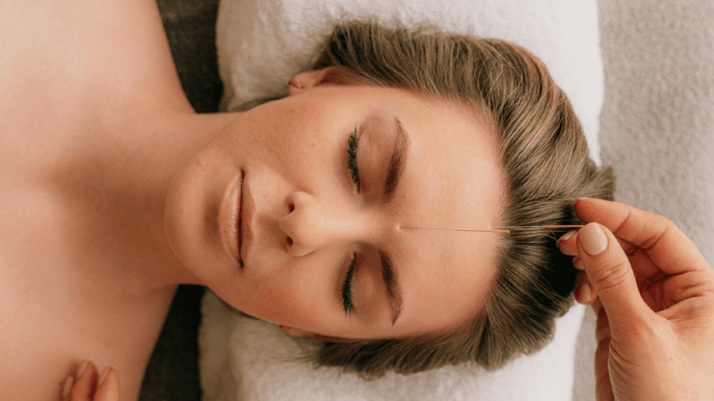 Facial acupuncture_3 | Treatwell